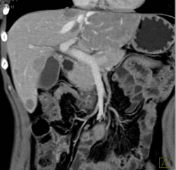 Hepatoma - CTisus CT Scan