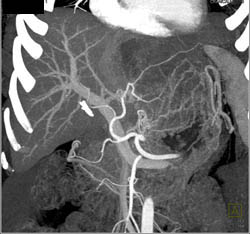 Hepatoma - CTisus CT Scan