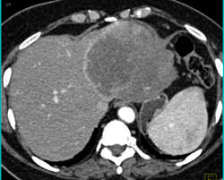 Hepatoma - CTisus CT Scan