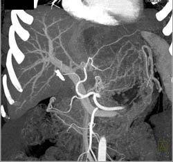 Hepatoma - CTisus CT Scan