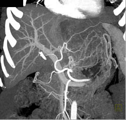 Hepatoma - CTisus CT Scan