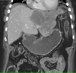 Hepatoma - CTisus CT Scan