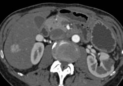 Focal Nodular Hyperplasia (FNH) - CTisus CT Scan