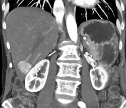 Focal Nodular Hyperplasia (FNH) - CTisus CT Scan