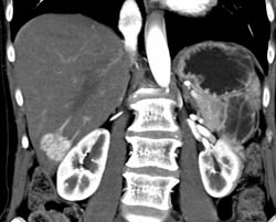 Focal Nodular Hyperplasia (FNH) - CTisus CT Scan