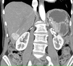 Focal Nodular Hyperplasia (FNH) - CTisus CT Scan