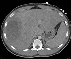 Liver Abscess With Enhancing Rim - CTisus CT Scan