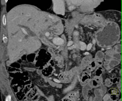 Cholangiocarcinoma of the Bile Duct - CTisus CT Scan