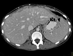 See Sequence - Hot Spot Liver Due to SVC Occlusion and Collaterals - CTisus CT Scan