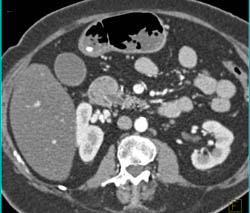 Stricture at Distal Common Bile Duct (CBD) - CTisus CT Scan