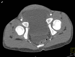 Embryonal Sarcoma of the Liver - CTisus CT Scan