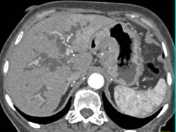 Cholangiocarcinoma - CTisus CT Scan