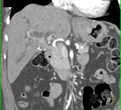 Cholangiocarcinoma - CTisus CT Scan