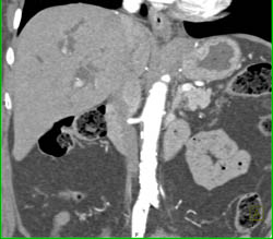 Cholangiocarcinoma - CTisus CT Scan