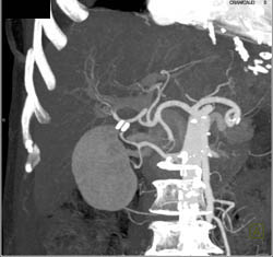 Cholangiocarcinoma - CTisus CT Scan