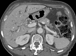 Cholangiocarcinoma - CTisus CT Scan