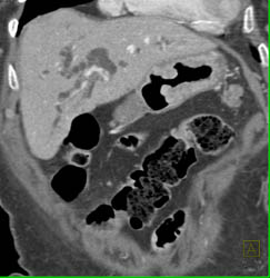 Cholangiocarcinoma - CTisus CT Scan