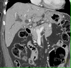 Cholangiocarcinoma - CTisus CT Scan