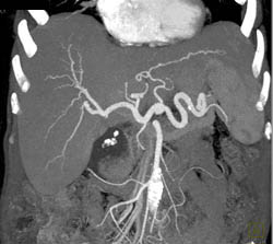 Normal Hepatic Artery Branching - CTisus CT Scan