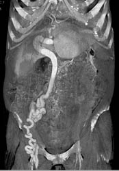 Cirrhosis With Recanalization of Umbilical Vein and Huge Varices - CTisus CT Scan