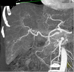 CTA With Hepatoma - CTisus CT Scan