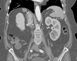 Cirrhosis With Recurrent Hepatocellular Carcinoma (HCC) - CTisus CT Scan