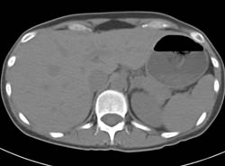 Full Sequence of Focal Nodular Hyperplasia (FNH) From Non-contrast to Delayed Phase - CTisus CT Scan