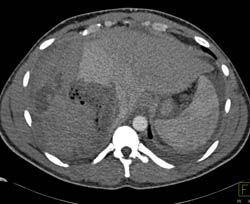 Ruptured Hepatic Adenoma With Bleed - CTisus CT Scan