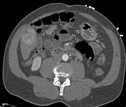 Hepatoma in A Cirrhotic Liver - CTisus CT Scan