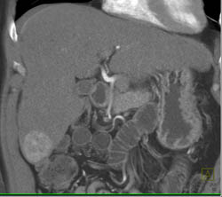 Hepatoma in A Cirrhotic Liver - CTisus CT Scan