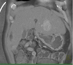 Hepatoma in A Cirrhotic Liver - CTisus CT Scan