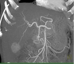 Hepatoma in A Cirrhotic Liver - CTisus CT Scan