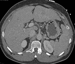 Hepatoma in A Cirrhotic Liver - CTisus CT Scan