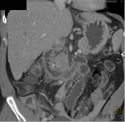 Hepatoma in A Cirrhotic Liver - CTisus CT Scan