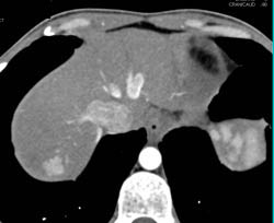 Focal Nodular Hyperplasia (FNH) - CTisus CT Scan