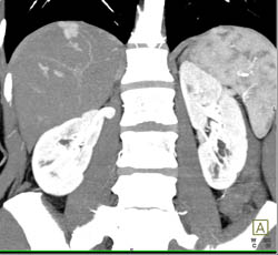 Focal Nodular Hyperplasia (FNH) - CTisus CT Scan