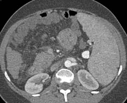 Cirrhosis With Splenomegaly and Splenic Artery Aneurysm - CTisus CT Scan