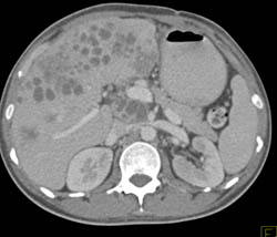 Recurrent Colon Cancer With Adenopathy in Celiac Nodal Chain - CTisus CT Scan