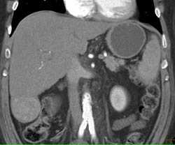 Focal Nodular Hyperplasia (FNH) - CTisus CT Scan