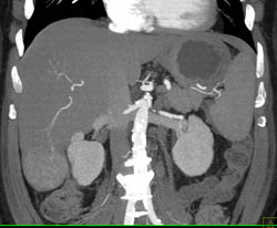 Focal Nodular Hyperplasia (FNH) - CTisus CT Scan