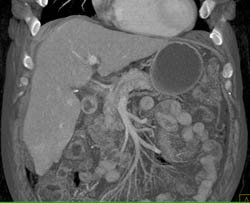 Focal Nodular Hyperplasia (FNH) - CTisus CT Scan