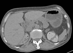 Renal Cell Carcinoma With Bilateral Nephrectomies and Metastases to the Pancreas and to the Liver- See Full Sequence - CTisus CT Scan