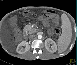 Hepatoma With Cavernous Transformation of the Portal Vein (CTPV) and Cirrhosis - CTisus CT Scan