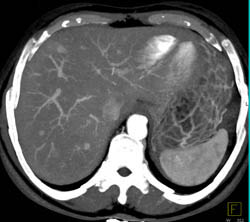 Metastatic Carcinoid Tumor to the Liver - CTisus CT Scan