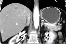 Islet Cell Tumor With Liver Metastases - CTisus CT Scan