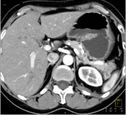 Islet Cell Tumor With Liver Metastases - CTisus CT Scan