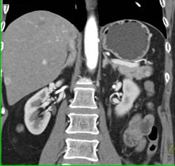 Islet Cell Tumor With Liver Metastases - CTisus CT Scan