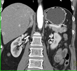 Islet Cell Tumor With Liver Metastases - CTisus CT Scan