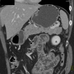 Islet Cell Tumor With Liver Metastases - CTisus CT Scan