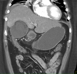 Emphysematous Cholecystitis With Stent in Common Bile Duct (CBD) - CTisus CT Scan